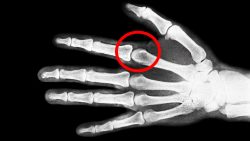 Ist Fingerknacken Gefährlich ist fingerknacken gefaehrlich