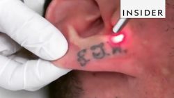 tattoos weg lasern lassen