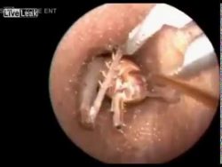 Würmer aus dem Ohr entfernen wuermer aus dem ohr entfernen