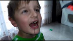 zaehne ziehen ganz xtreeem bei k